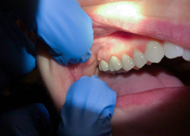 Best Emergency Tooth Extraction in Soh Willard, UT